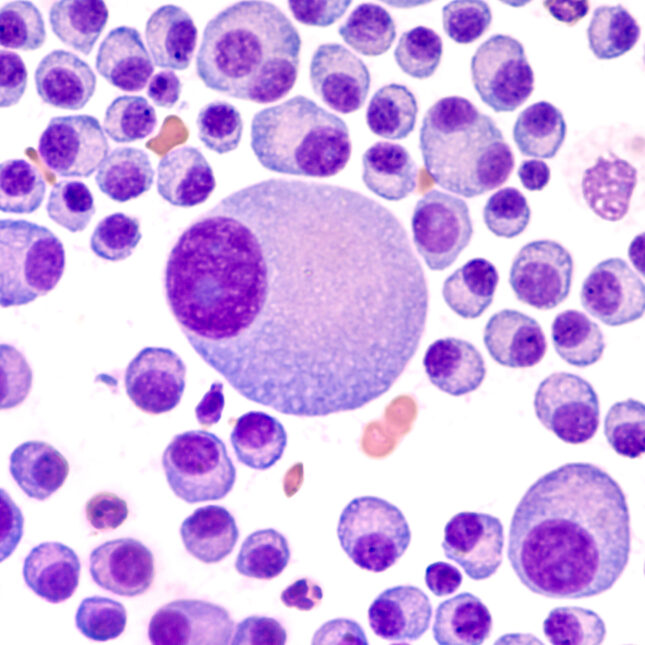 malignant plasma cells of multiple myeloma