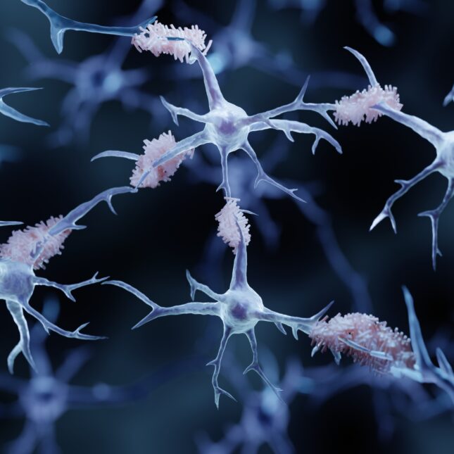 Amyloid plaques, causing Alzheimer's disease, build up in brain tissue — coverage from STAT